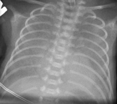 respiratory distress syndrome x ray