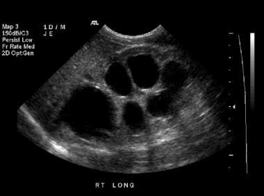 Longitudinal sonogram of the right kidney in a 1-d