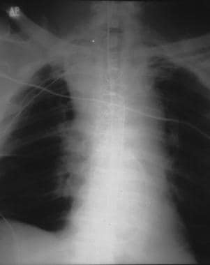 Aorta, trauma. Chest radiograph shows widening of 