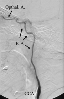Lateral carotid angiogram shows that the cervical 