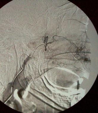 Digital-subtraction angiogram of the right interna