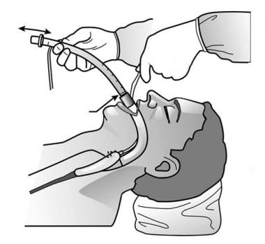 Intubating through the ILMA. 