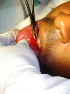 Closure of an intraoral laceration. 