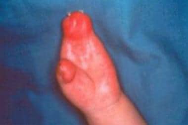 Hand of a patient with Apert syndrome showing synd