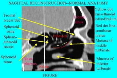 CT scan, nasal cavity. This reformatted image of a
