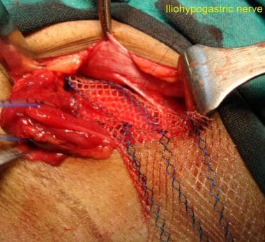 Open inguinal hernia repair. Slit made in mesh to 