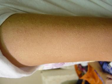Classic skin-colored bumps on upper arm of young w