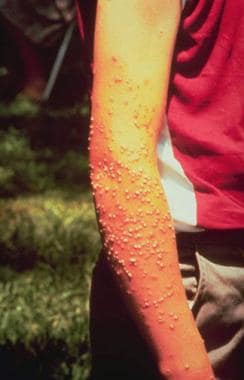 Pustules and blisters formed following fire ant st