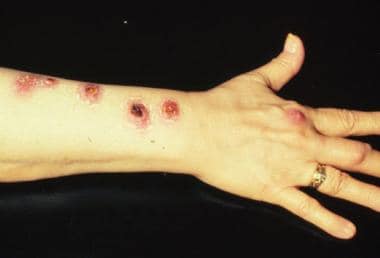 Mycobacterium marinum is an atypical mycobacteria 