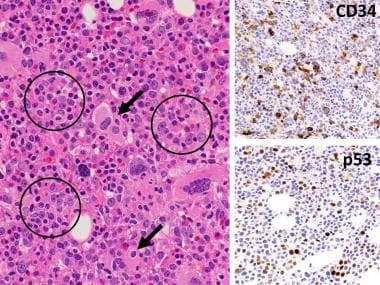 Pathology of Acute Myeloid Leukemia With Myelodysp