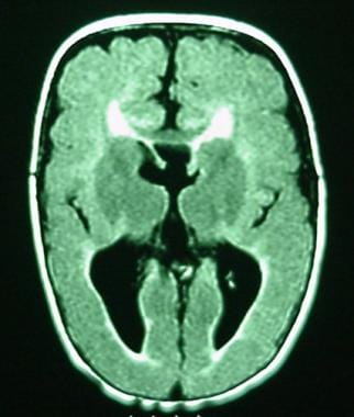 Magnetic resonance image (MRI) of a 1-year-old boy