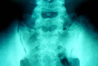 Bilateral symmetric sacroiliitis in a patient with