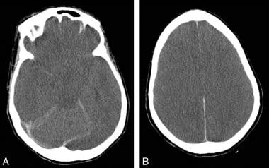 CT scan of cerebral edema caused by hyperammonemia