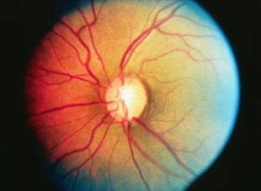 Primary Open-Angle Glaucoma (POAG): Practice Essentials, Background,  Pathophysiology