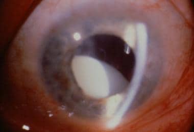 Ectopia lentis. Dislocated traumatic lens (catarac