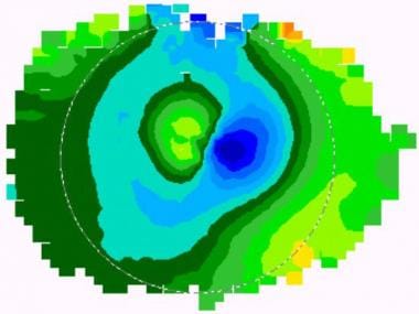 Corneal topography of a central island. 