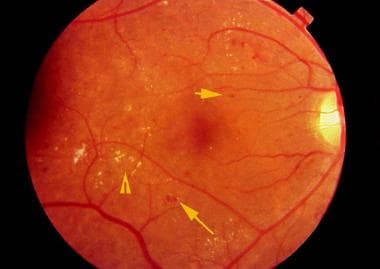 Retinal findings in background diabetic retinopath