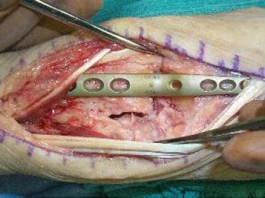 Wrist arthrodesis. Intraoperative view after plate