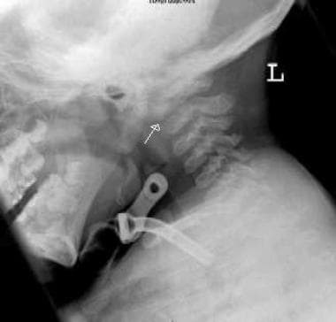 Spondyloepiphyseal dysplasia. Radiograph of the up