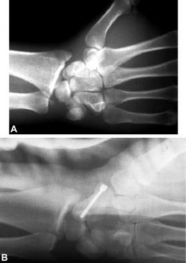 A is a lateral radiograph typical of transscaphoid