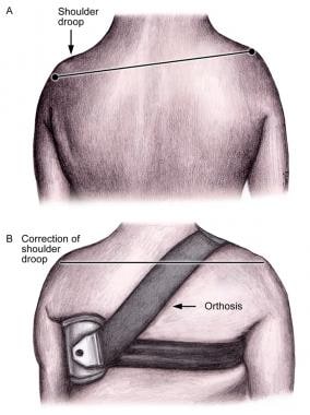 Shoulder orthosis for scapulohumeral alignment. 