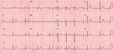 Sinus Node Dysfunction Workup: Approach Considerations, Ambulatory ECG (Holter) Monitoring and Event Recording