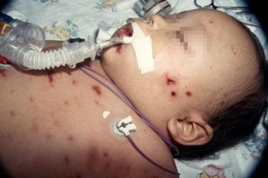 A 9-month-old baby in septic shock with purpuric N