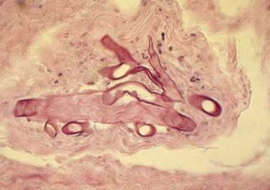 A tissue hematoxylin and eosin stain of Rhizopus s