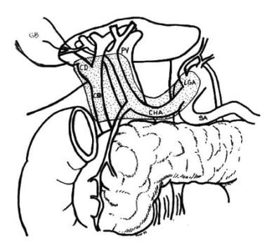 Gallbladder Cancer Treatment & Management: Approach Considerations, Surgical  Care, Consultations