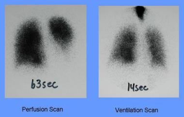 Anterior views of perfusion and ventilation scans 