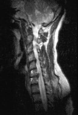 Sagittal magnetic resonance imaging (MRI) scan of 