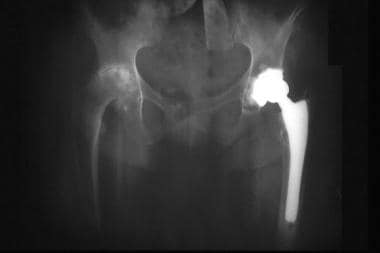 Anteroposterior radiograph of the pelvis and hips 