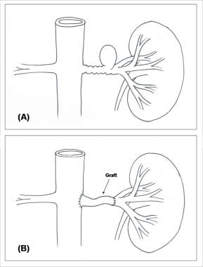 Renal Artery Aneurysm Treatment & Management: Approach Considerations,  Surgical Therapy, Endovascular Therapy