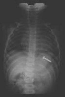 A screw in the stomach; peristaltic action will ca