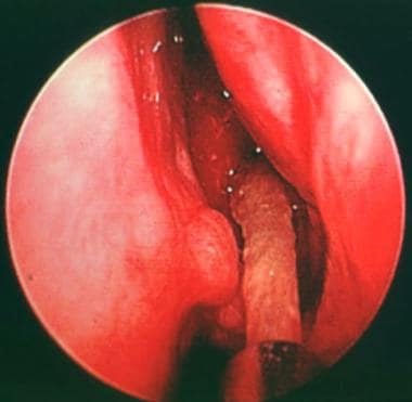 fungal sinus infection