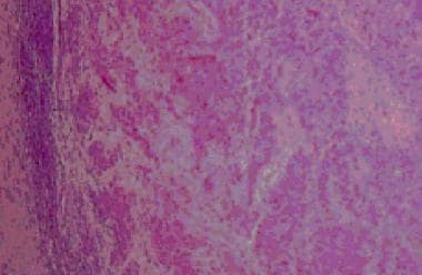 Histologic appearance of metastatic squamous cell 