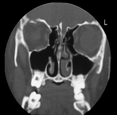 lamina papyracea fracture