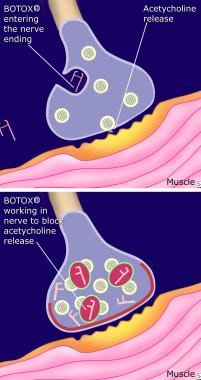 Myofascial pain in athletes. Mechanism of botulinu