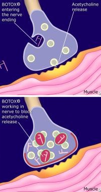 trapezius-trigger-point-interactions