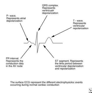 Pediatric Right Bundle Branch Block. This image de