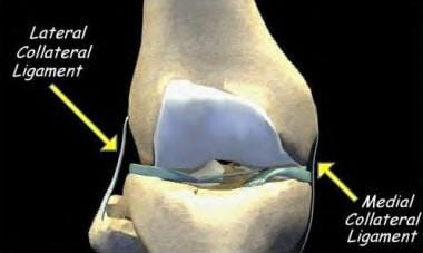 Lateral Ligament Injury - Sports Medicine Information