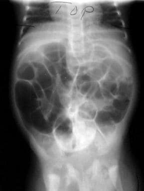 Pediatric Small Bowel Obstruction. This image reve