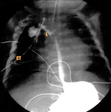 Anastomosis disruption following repair of esophag