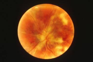 chorioretinitis neonate