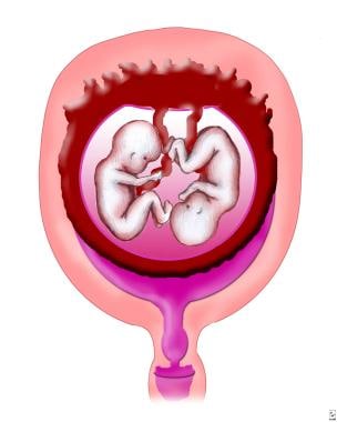 Monochorionic/monoamniotic placentation. 