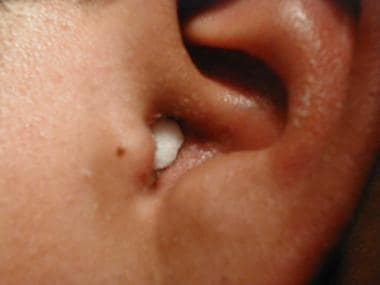 Close up of abscess Inflammation on the ear, area of suppuration