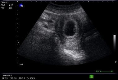 Picture of gestational sac with yolk sac. 