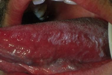 Lateral tongue in oral hairy leukoplakia.
