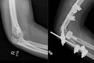 Chronic elbow fracture dislocation presentation fi