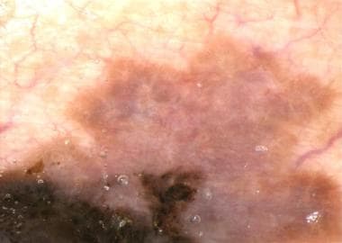 White areas in invasive melanoma. 